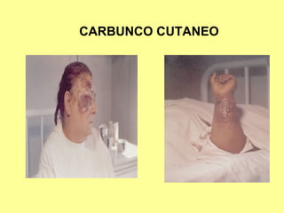 CARBUNCO CUTANEO

 