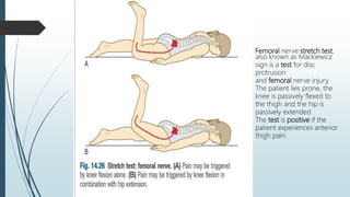 Femoral nerve stretch test,
also known as Mackiewicz
sign is a test for disc
protrusion
and femoral nerve injury.
The patient lies prone, the
knee is passively flexed to
the thigh and the hip is
passively extended.
The test is positive if the
patient experiences anterior
thigh pain.
 