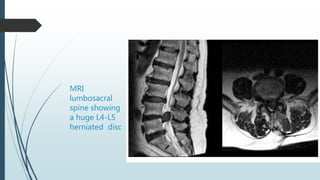 MRI
lumbosacral
spine showing
a huge L4-L5
herniated disc
 