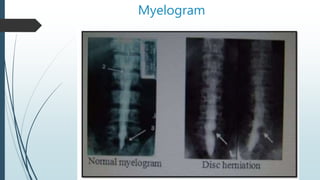 Myelogram
 
