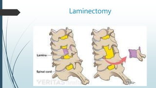 Laminectomy
 