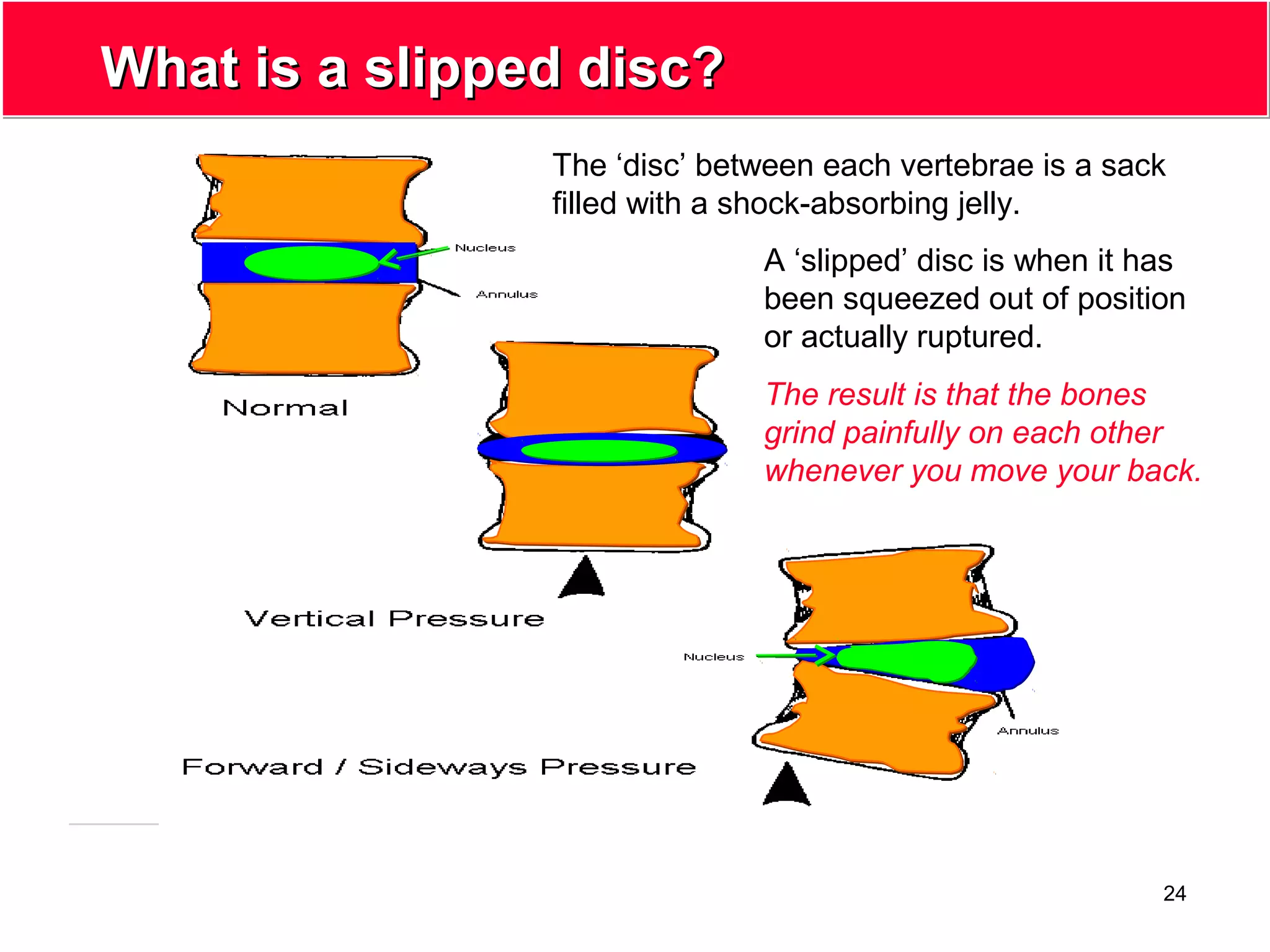 24
What is a slipped disc?What is a slipped disc?
The ‘disc’ between each vertebrae is a sack
filled with a shock-absorbing jelly.
A ‘slipped’ disc is when it has
been squeezed out of position
or actually ruptured.
The result is that the bones
grind painfully on each other
whenever you move your back.
 