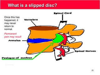 25
What is a slipped disc?What is a slipped disc?
Once this has
happened, it
may never
return to
normal.
Permanent
pain may result
 