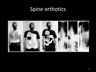 Spine orthotics
23
 