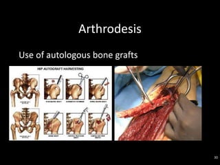 Arthrodesis
Use of autologous bone grafts
30
 