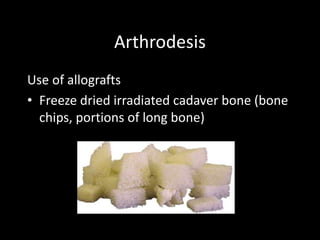 Arthrodesis
Use of allografts
• Freeze dried irradiated cadaver bone (bone
chips, portions of long bone)
 