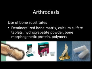 Arthrodesis
Use of bone substitutes
• Demineralized bone matrix, calcium sulfate
tablets, hydroxyapatite powder, bone
morphogenetic protein, polymers
 