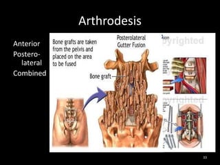 Arthrodesis
Anterior
Postero-
lateral
Combined
33
 