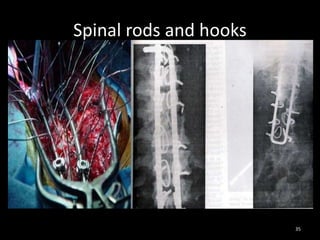 Spinal rods and hooks
35
 