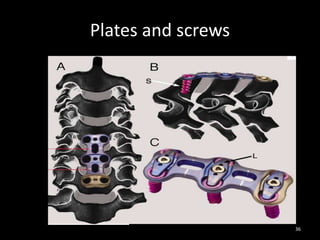 Plates and screws
36
 