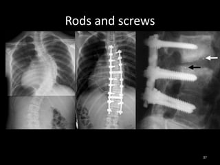 Rods and screws
37
 