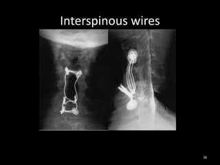 Interspinous wires
38
 