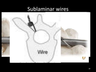 Sublaminar wires
39
 