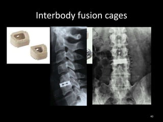 Interbody fusion cages
40
 