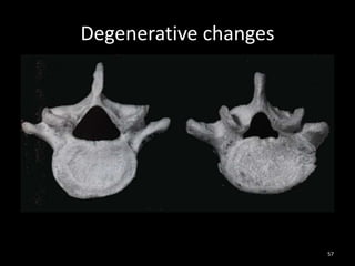 Degenerative changes
57
 