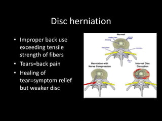 Disc herniation
• Improper back use
exceeding tensile
strength of fibers
• Tears=back pain
• Healing of
tear=symptom relief
but weaker disc
 