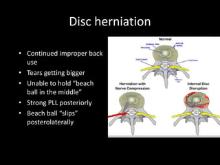 Disc herniation
• Continued improper back
use
• Tears getting bigger
• Unable to hold “beach
ball in the middle”
• Strong PLL posteriorly
• Beach ball “slips”
posterolaterally
 