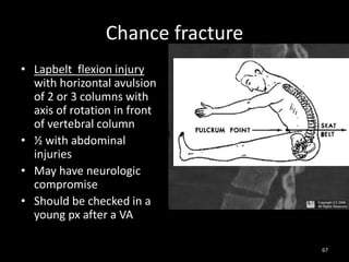Chance fracture
• Lapbelt flexion injury
with horizontal avulsion
of 2 or 3 columns with
axis of rotation in front
of vertebral column
• ½ with abdominal
injuries
• May have neurologic
compromise
• Should be checked in a
young px after a VA
67
 