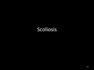 Scoliosis
78
 