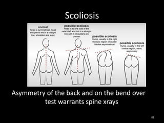 Scoliosis
Asymmetry of the back and on the bend over
test warrants spine xrays
81
 