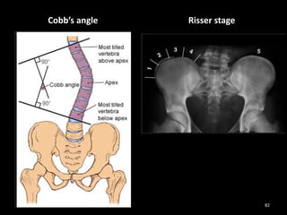 Cobb’s angle Risser stage
82
 