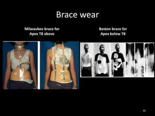 Brace wear
Milwaukee brace for
Apex T8 above
Boston brace for
Apex below T8
85
 