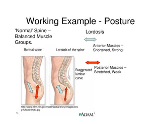 10/6/2010 Sharon Sharpe, ScD, ATC
Working Example - Posture
http://www.nlm.nih.gov/medlineplus/ency/images/enc
y/fullsize/9583.jpg
‘Normal’ Spine –
Balanced Muscle
Groups.
Anterior Muscles –
Shortened, Strong
Posterior Muscles –
Stretched, Weak
Lordosis
 