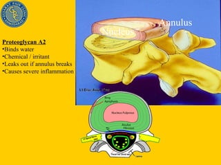 Annulus Nucleus Proteoglycan A2 Binds water Chemical / irritant Leaks out if annulus breaks Causes severe inflammation 