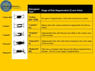 CONTRAST DISTRIBUTION [80] : (AS EVALUATED BY FLUOROSCOPY )     Disk has a complete radio fissure that allows injected fluid to escape.  Can be in any stage of degeneration.   “ Ruptured”  (R)   Degenerated disk with radio fissure leading to the outer edge of the annulus.   “ Fissured” (F)   Degenerated disk with fissures and clefts in the nucleus and inner annulus.   “ Irregular”  (I)   Mature disk with nucleus starting to degenerate into fibrous lumps.   “ Lobular”  (L)   No signs of degeneration, Soft white amorphous nucleus   “ Cotton Ball”  (CB)   Stage of Disk Degeneration (C-arm View)   Discogram Type “ Ruptured” “ Fissured” “ Irregular” “ Lobular” “ Cotton Ball” 