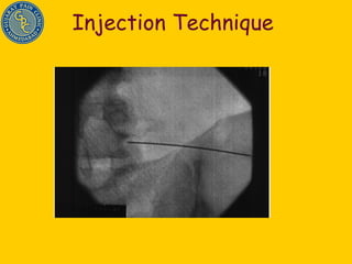 Injection Technique 