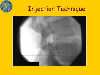 Injection Technique 
