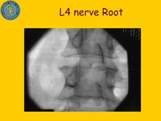 L4 nerve Root 