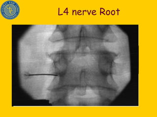 L4 nerve Root 