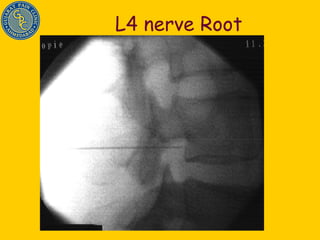 L4 nerve Root 
