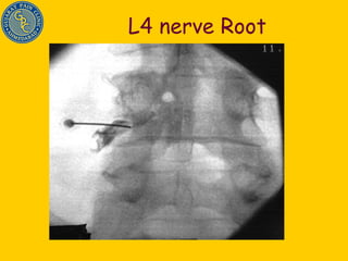 L4 nerve Root 