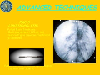 ADVANCED TECHNIQUES RAC’S ADHESIONOLYSIS   Failed Back Syndrome, Radiculopathies, LCS etc not responding to previous mentioned procedures  RACZ Catheter – special spring loaded catheter with blunt tip 