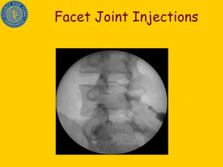 Facet Joint Injections 