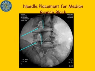 Needle Placement for Median Branch Block 