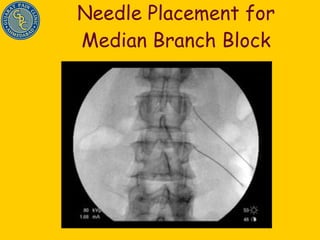 Needle Placement for Median Branch Block 