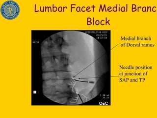 Lumbar Facet Medial Branch Block Needle position at junction of SAP and TP Medial branch of Dorsal ramus 