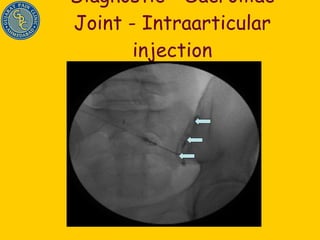 Diagnostic - Sacroiliac Joint - Intraarticular injection 