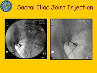 Sacral Iliac Joint Injection 