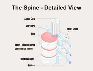 The Spine - Detailed View Facet Joint Spinal Cord Vertebra Disc Inner - disc material pressing on nerve Ruptured Disc Nerves 