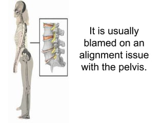 It is usually
 blamed on an
alignment issue
with the pelvis.
 