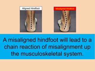 Aligned Hindfoot   Misaligned Hindfoot




A misaligned hindfoot will lead to a
chain reaction of misalignment up
   the musculoskeletal system.
 