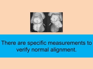 There are specific measurements to
     verify normal alignment.
 