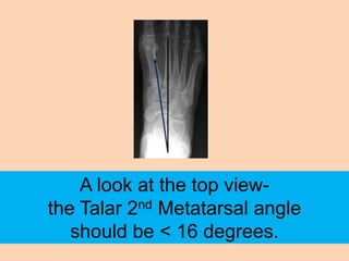 A look at the top view-
the Talar 2nd Metatarsal angle
   should be < 16 degrees.
 