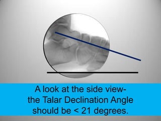 A look at the side view-
the Talar Declination Angle
 should be < 21 degrees.
 