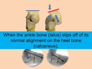 When the ankle bone (talus) slips off of its
  normal alignment on the heel bone
             (calcaneus),
 