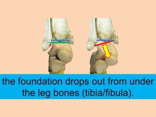 the foundation drops out from under
     the leg bones (tibia/fibula).
 